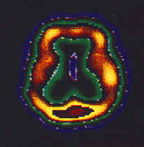 SPECT bei Alzheimer